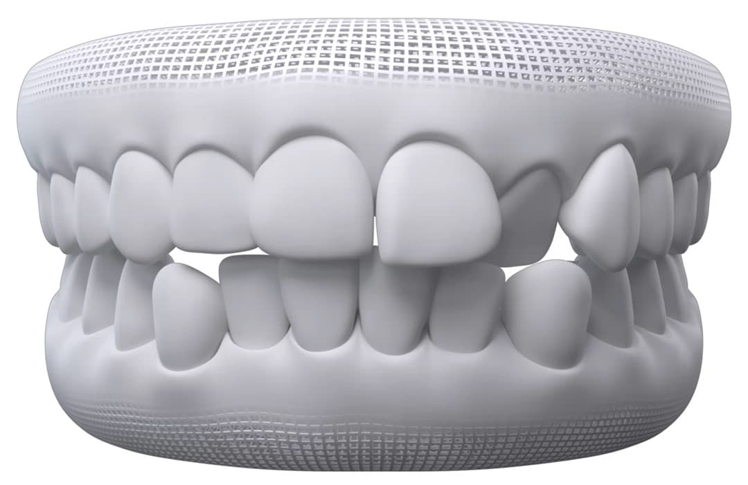 https://www.invisalign.com/_next/image?url=https%3A%2F%2Fimages.ctfassets.net%2Fvh25xg5i1h5l%2F1BMrWleJSYuSw0VEAclGlh%2Fd38ebbd46f30c5244552f0ed113f33e9%2Fvideo-resources-straighter-teeth-timelapse-thumbnail.jpg&w=3840&q=75